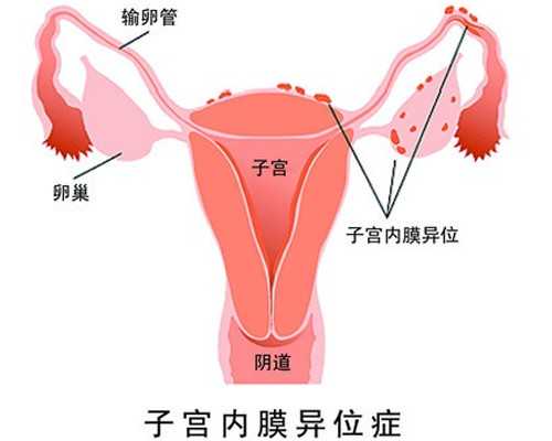 阿托品能治疗痛经吗？继发性痛经可以生孩子吗？